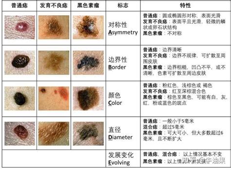 女生長痣|痣是什麼？會變成黑色素瘤？7種一定要除的痣